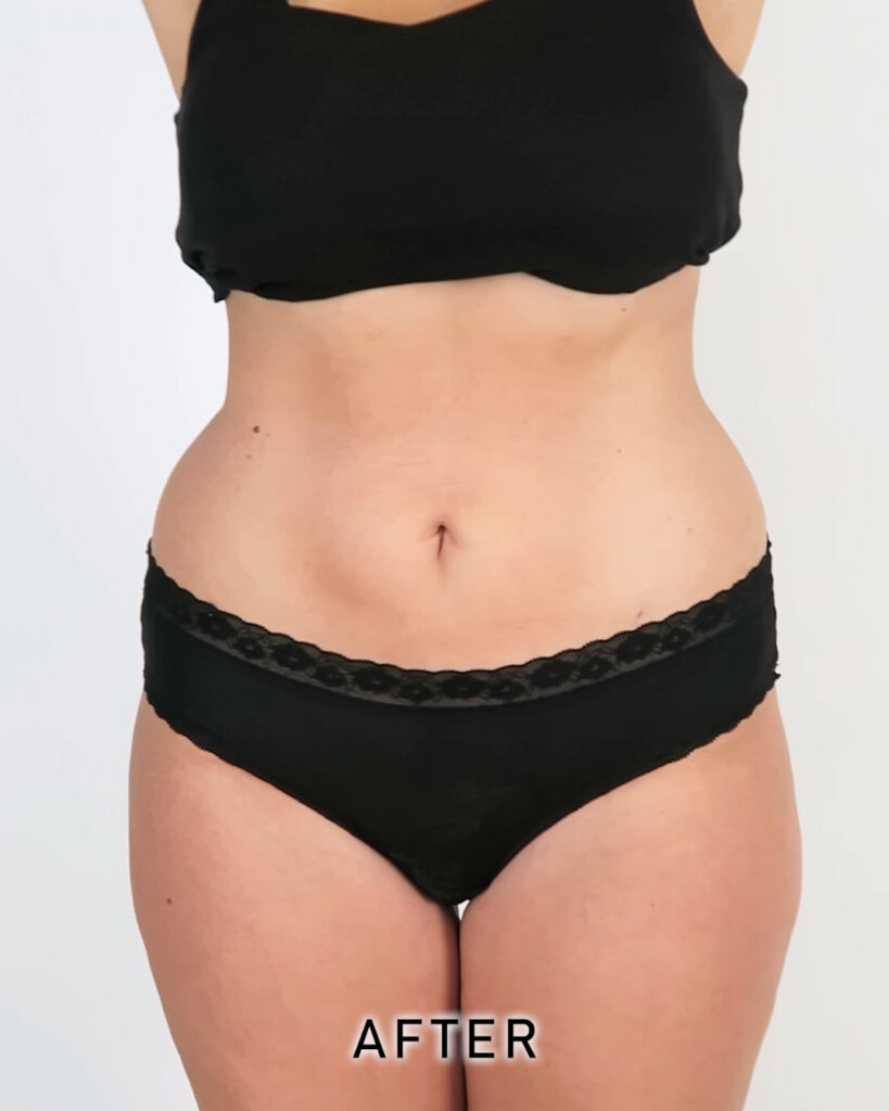cdm-videos-gallery-smart-lipo-003-img-001