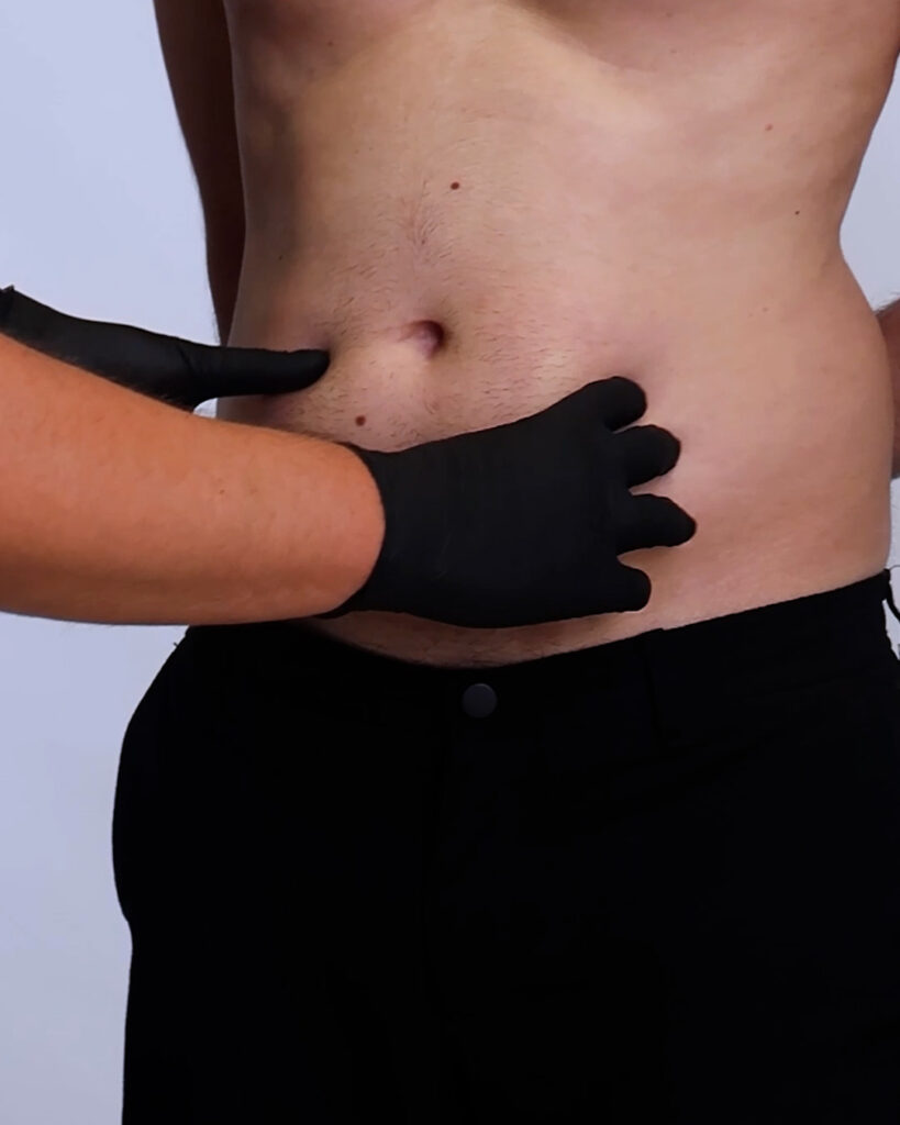 cdm-videos-gallery-smart-lipo-005-img-001